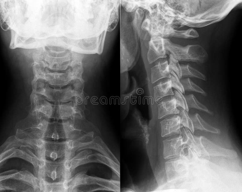 Xray of Neck and Cervical Spine Stock Photo Image of digital, disc