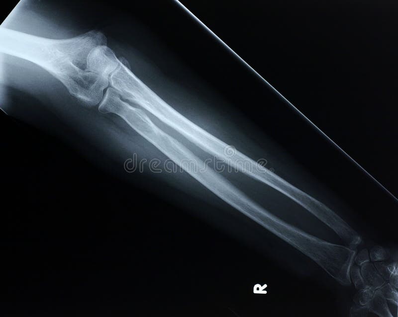Xray przednia przedramienia zdjęcie royalty free