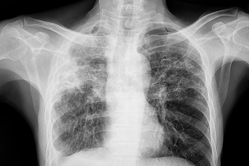 Xray Torácico Del Paciente Con Tuberculosis Pulmonar Imagen de archivo