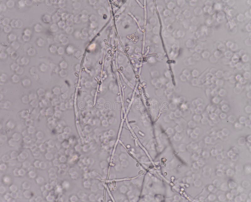 Yeast Cells in Urine Sample. Stock Image Image of yellow, cells 92346447