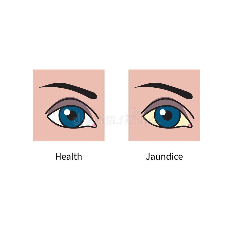 Yellow Sclera of Eyeball in Hepatitis Stock Vector Illustration of