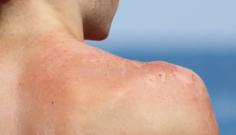 Young boy skin is peeling after sunburn