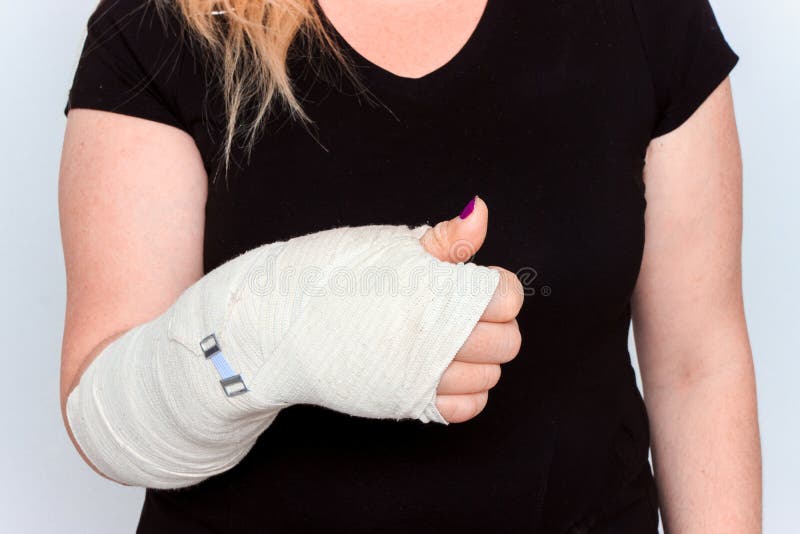 Young female with broken hand in cast. 