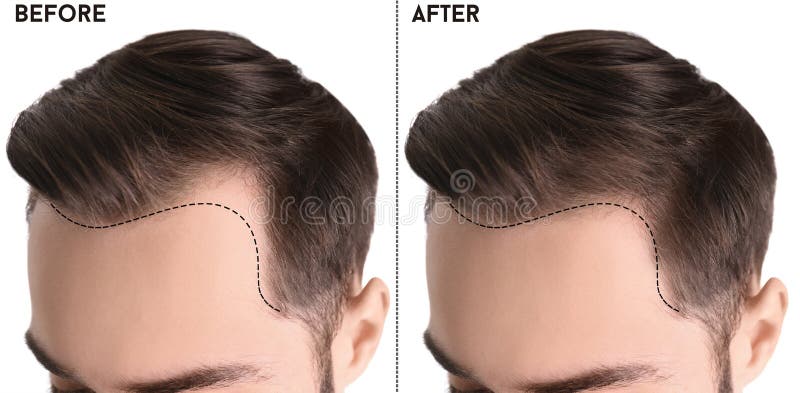 Young man before and after hair loss treatment against white background