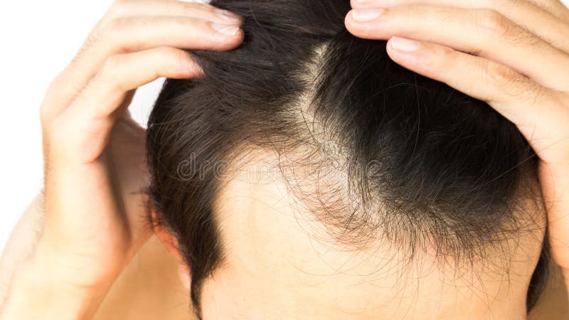 can hair loss be a sign of something serious