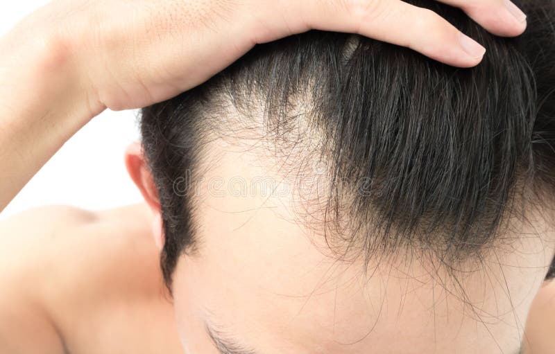 Young man serious hair loss problem for health care shampoo and