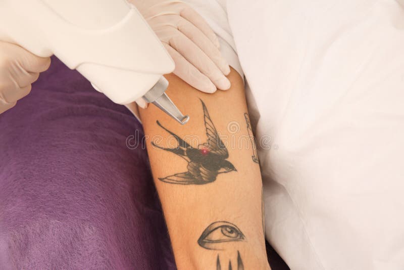 Young Man Undergoing Laser Tattoo Removal Procedure in Salon, Closeup Stock Photo Image of
