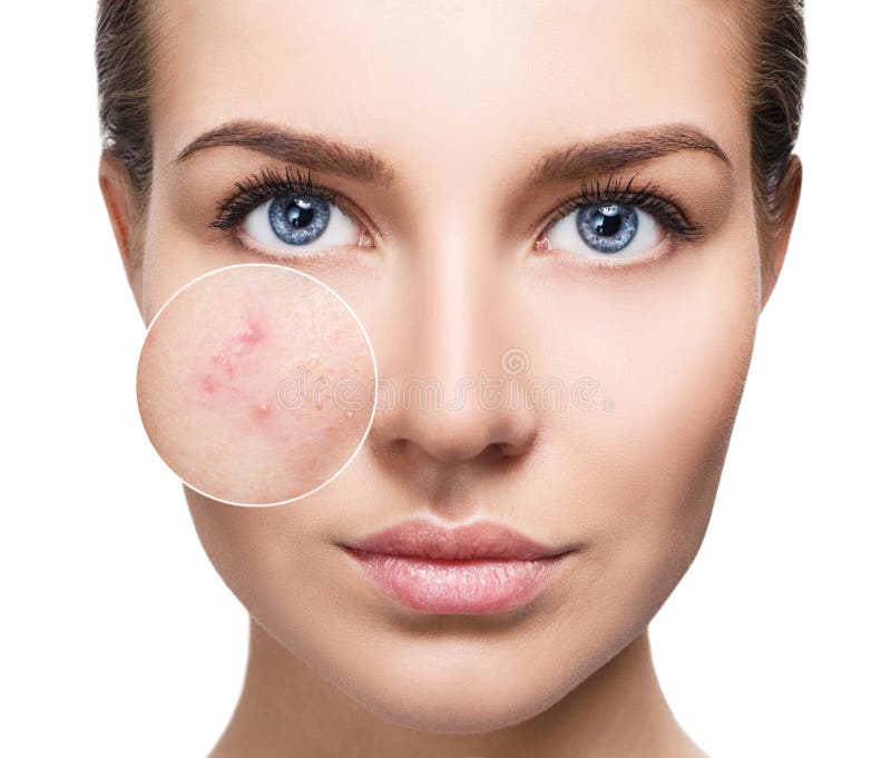 Young woman with acne skin in zoom circle. stock photo Young woman with acne skin in zoom circle. stock photo