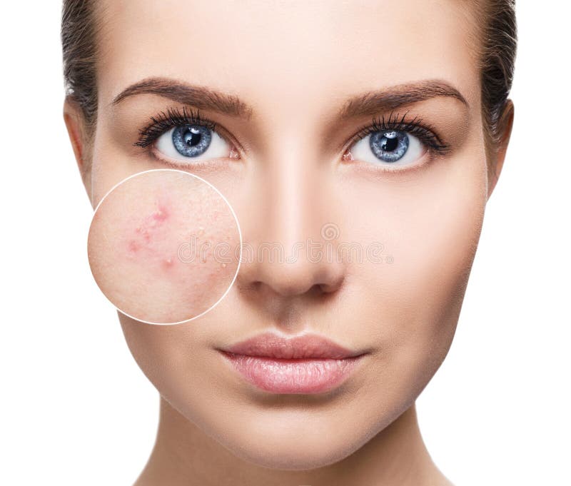 Young woman with acne skin in zoom circle.