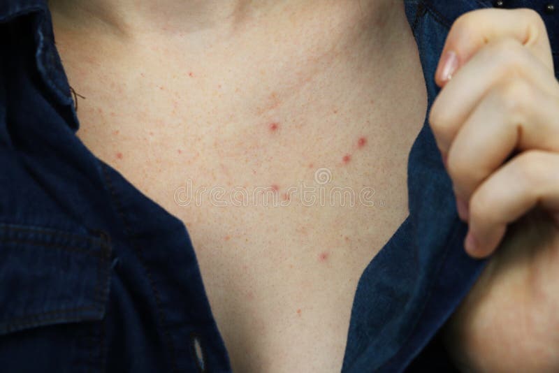 Allergy concept. Young woman with pimples on the chest, closeup