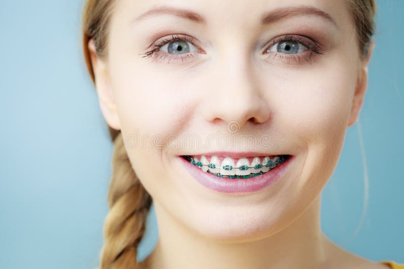 Young Woman Showing Teeth Braces Stock Image - Image of teen, dental ...