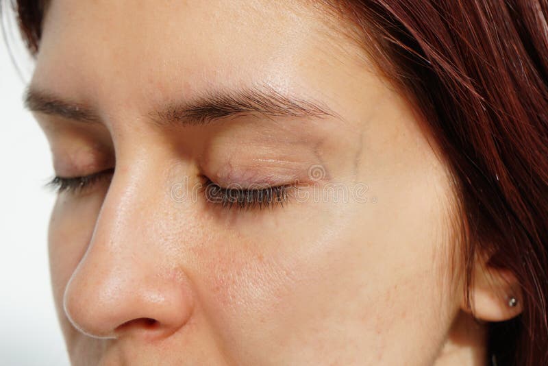 Young woman with spider veins and broken capillaries around eyes