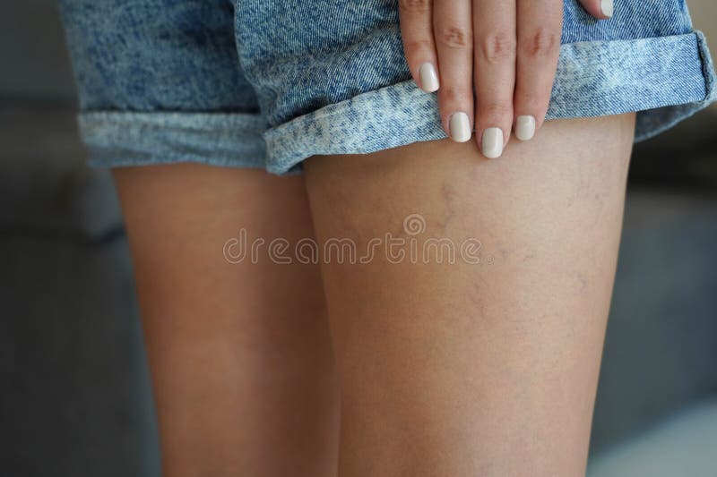 Young woman with varicose and spider veins on her leg. Close-up of skin problem on woman leg