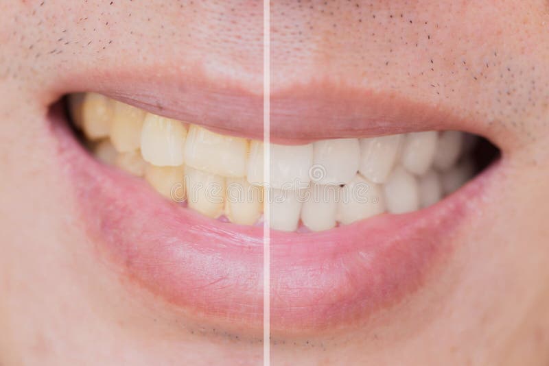 Zahnlaser-Bleichmittel im männlichen Mannzahn weiß werden, vergleichen Sie vor af stockbild Zahnlaser-Bleichmittel im männlichen Mannzahn weiß werden, vergleichen Sie vor af stockbild