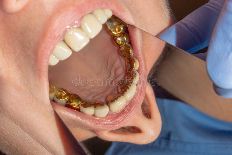 Zahnmedizinische Wiederherstellung von faulen Wurzeln der Zähne mit keramis...