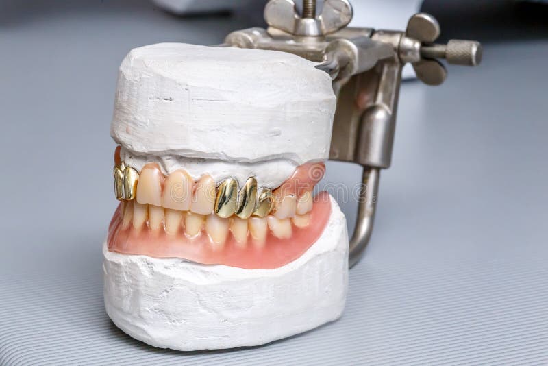 Zahnmedizinisches Goldzähne Prothese, menschliches Zahnfleischmodell der Lehmform stockbilder Zahnmedizinisches Goldzähne Prothese, menschliches Zahnfleischmodell der Lehmform stockbilder