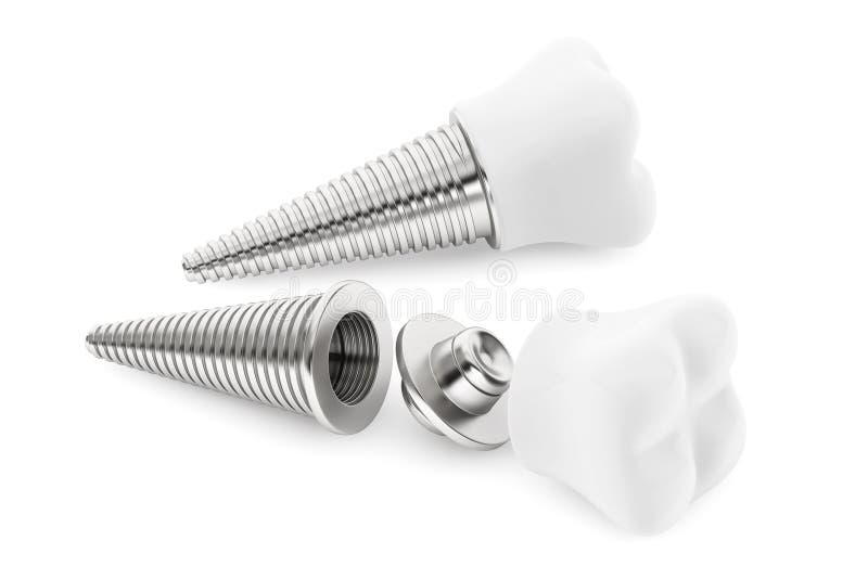 Zahnmedizinisches Konzept. Zahn-Implantat lizenzfreie stockfotos