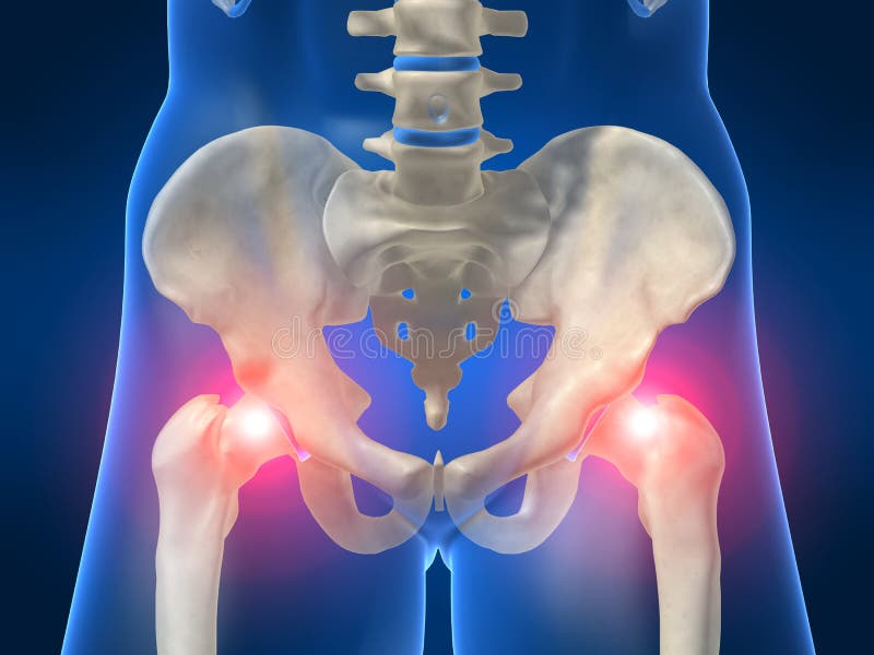 zapalenie biodra ilustracji zapalenie biodra ilustracji