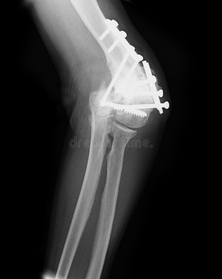 Zdradzony łokcia xray zdjęcie royalty free
