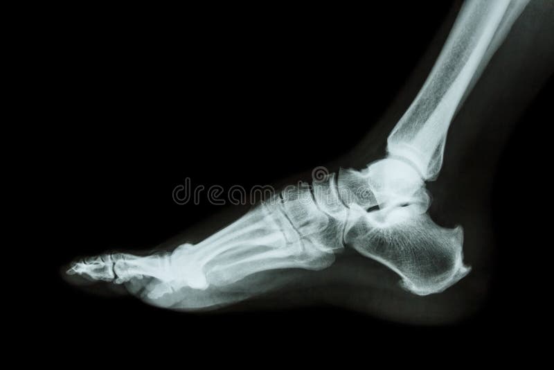 Zijde van de röntgenstraal de normale voet
