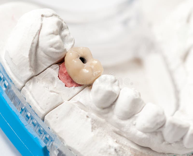 Zirconia Crown Over Implants Stock Photo Image of oral, endodontia