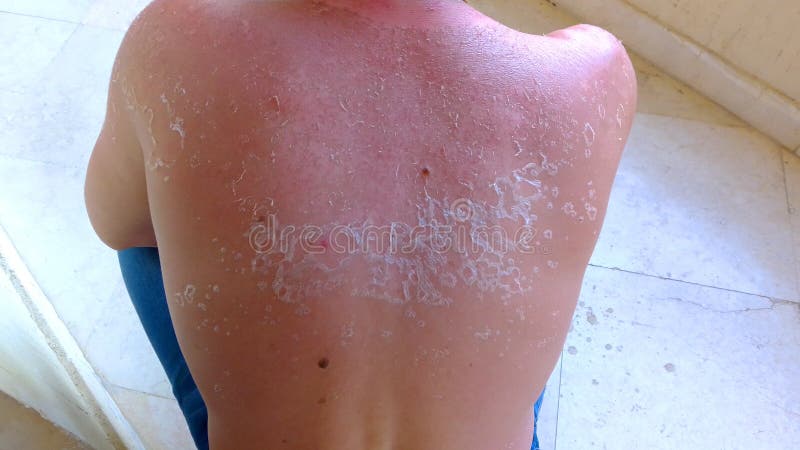 Sunburn on the back and neck of a man, skin peeling and peeling, red spots, a painful condition of a person. Sunburn on the back and neck of a man, skin peeling and peeling, red spots, a painful condition of a person.