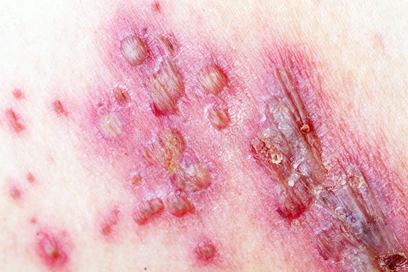 Zoster de herpes (tablas) foto de archivo libre de regalías Zoster de herpes (tablas) foto de archivo libre de regalías