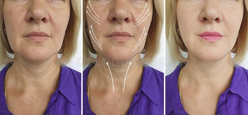 Old caucasian woman removal wrinkles before and after lifting  filler   therapy  correction tightening arrow mature sagging. Old caucasian woman removal wrinkles before and after lifting  filler   therapy  correction tightening arrow mature sagging