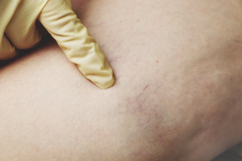 Åderbråcks åder och hårfina åder i benen Medicinsk kontroll och behandling arkivbild Åderbråcks åder och hårfina åder i benen Medicinsk kontroll och behandling arkivbild