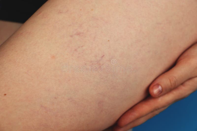 Åderbråcks åder och hårfina åder i benen Medicinsk kontroll och behandling royaltyfri fotografi Åderbråcks åder och hårfina åder i benen Medicinsk kontroll och behandling royaltyfri fotografi
