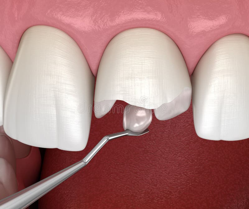 Återställande av bruten tand. medicinskt korrekt 3d-illustration royaltyfri illustrationer