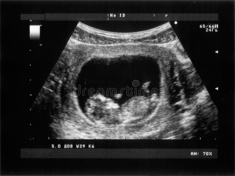 echographie 8 mois