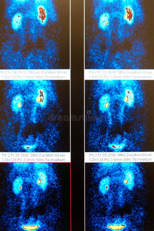 Renal flow frames of real nuclear scan reveals two kidneys with signs of obstruction which are brown and yellow colors in one of the kidney ,body in blue color, isotope in white color,reveals real filling of bladder in yellow color. Renal flow frames of real nuclear scan reveals two kidneys with signs of obstruction which are brown and yellow colors in one of the kidney ,body in blue color, isotope in white color,reveals real filling of bladder in yellow color