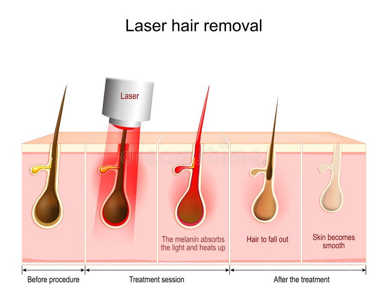 élimination des cheveux laser