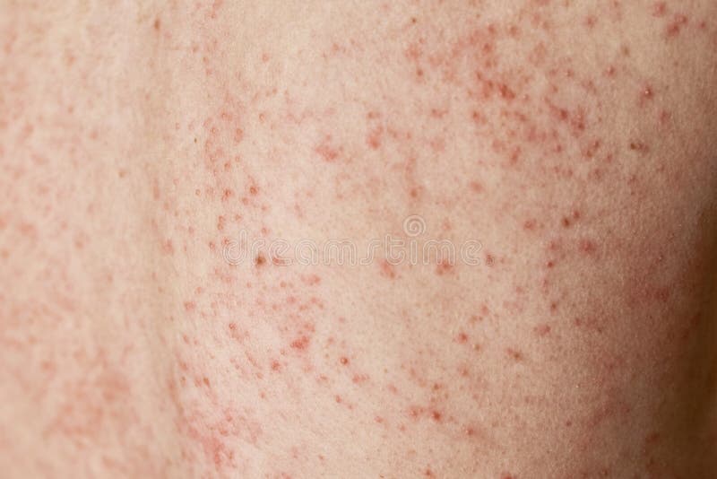 Éruption Allergique Sur La Peau Femme Avec Le Problème De Dermatologie