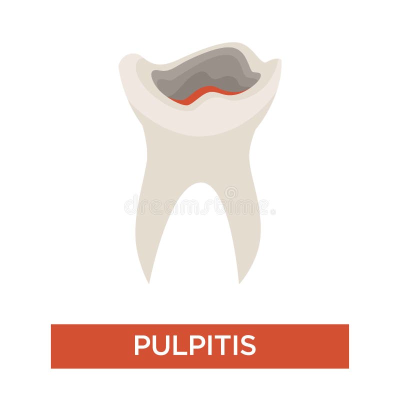 Зубоврачевание этапа костоеды спада зуба и зубоврачебное pulpitis здоровья иллюстрация штока Зубоврачевание этапа костоеды спада зуба и зубоврачебное pulpitis здоровья иллюстрация штока