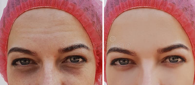 Eye swelling, wrinkles before and after cosmetic procedure removal. Eye swelling, wrinkles before and after cosmetic procedure removal