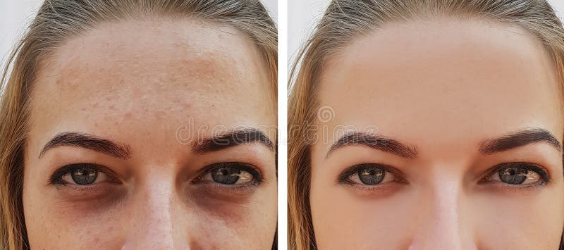 Eye girl bag under the eyes before and after cosmetic procedures treatment. Eye girl bag under the eyes before and after cosmetic procedures treatment