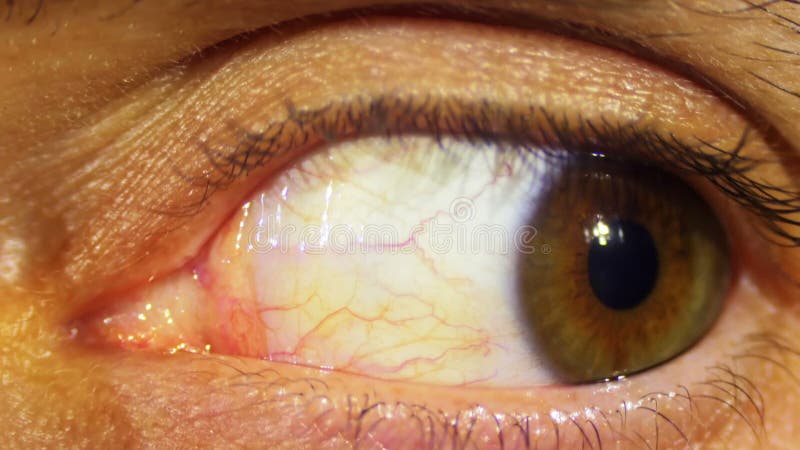 Ögonrotation av ögongloben