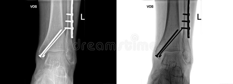 Łamany piętowy Xray załatwiający z śrubami i talerzem, stopa ból przy doktorskim biurem fotografia stock