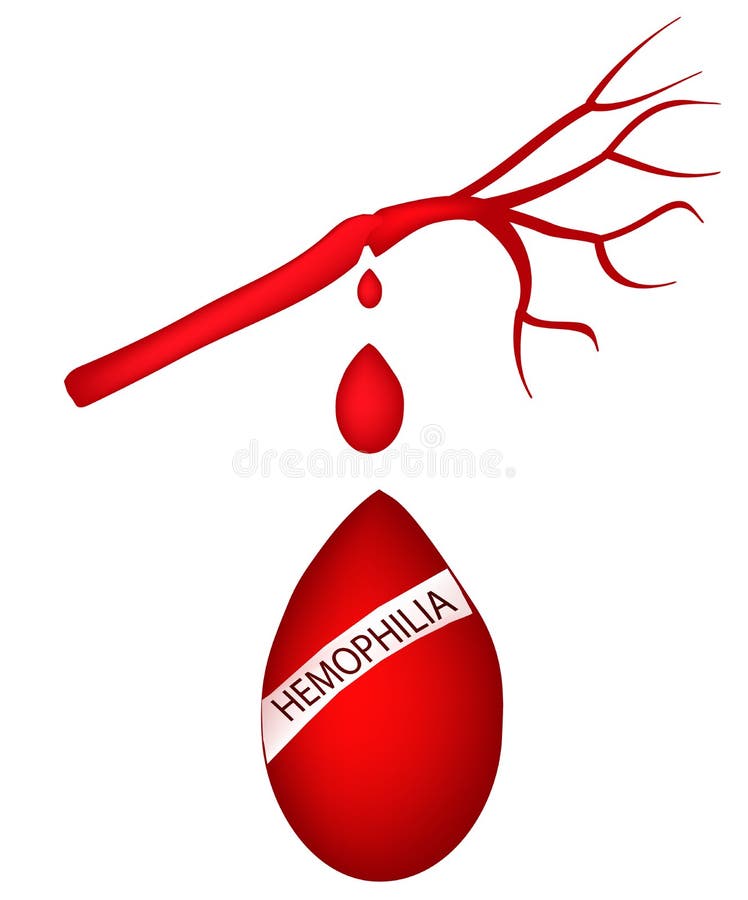 Światowy hemofilia dzień 17 Kwiecień Kropla krwi spływanie od arterii również zwrócić corel ilustracji wektora ilustracja wektor Światowy hemofilia dzień 17 Kwiecień Kropla krwi spływanie od arterii również zwrócić corel ilustracji wektora ilustracja wektor