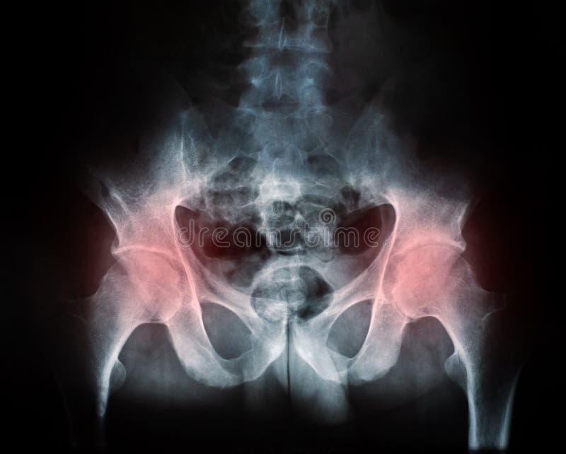 X-ray of a human break hip pain coxal joint. X-ray of a human break hip pain coxal joint