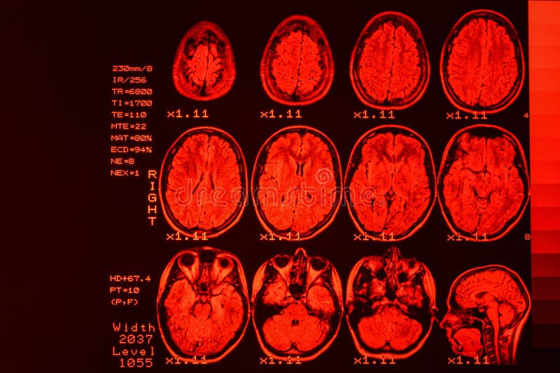 Ανίχνευση MRI ή εικόνα μαγνητικής αντήχησης της ανίχνευσης κεφαλιών και εγκεφάλου Το αποτέλεσμα είναι ένα MRI του εγκεφάλου με τι στοκ εικόνες με δικαίωμα ελεύθερης χρήσης Ανίχνευση MRI ή εικόνα μαγνητικής αντήχησης της ανίχνευσης κεφαλιών και εγκεφάλου Το αποτέλεσμα είναι ένα MRI του εγκεφάλου με τι στοκ εικόνες με δικαίωμα ελεύθερης χρήσης