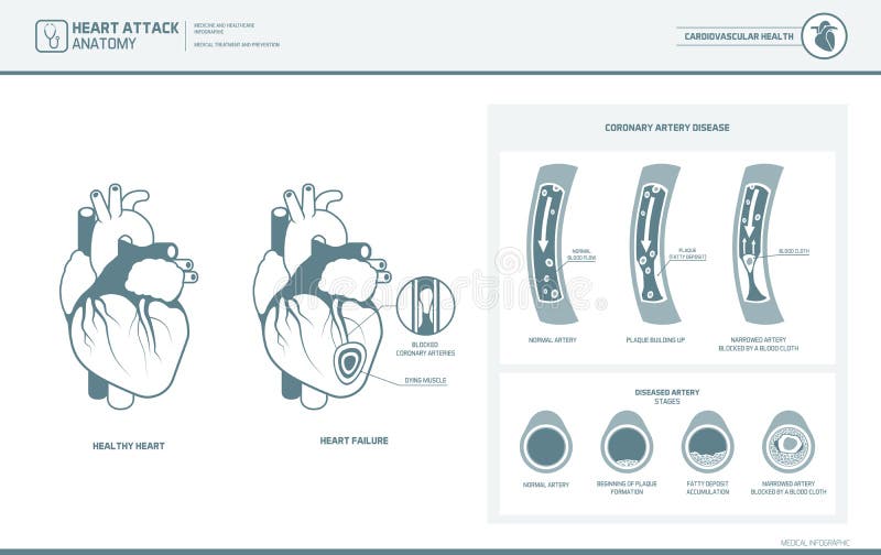 Heart attack and atherosclerosis medical illustration: healthy and damaged heart, blood vessel section with fatty deposit accumulation. Heart attack and atherosclerosis medical illustration: healthy and damaged heart, blood vessel section with fatty deposit accumulation