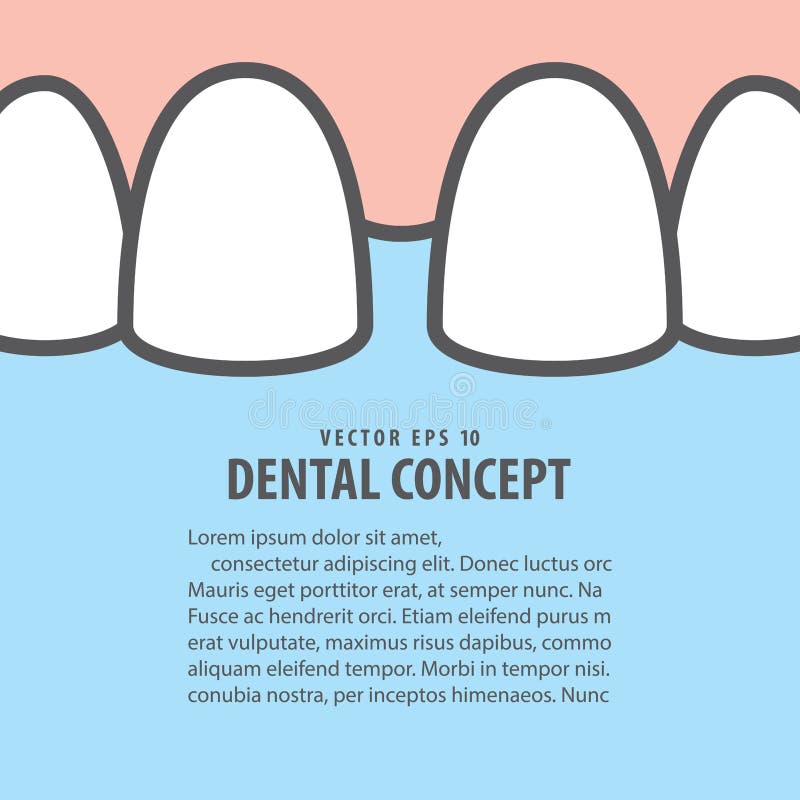 Ανώτερο διάνυσμα απεικόνισης δοντιών diastema κινηματογραφήσεων σε πρώτο πλάνο σχεδιαγράμματος στο μπλε διανυσματική απεικόνιση Ανώτερο διάνυσμα απεικόνισης δοντιών diastema κινηματογραφήσεων σε πρώτο πλάνο σχεδιαγράμματος στο μπλε διανυσματική απεικόνιση