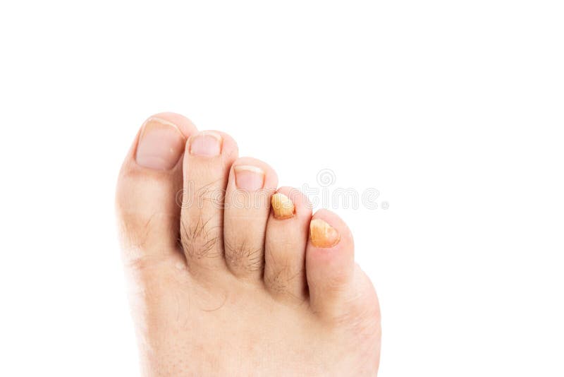 Αρσενικά toenails με τη μυκητιακή μόλυνση στοκ εικόνες με δικαίωμα ελεύθερης χρήσης Αρσενικά toenails με τη μυκητιακή μόλυνση στοκ εικόνες με δικαίωμα ελεύθερης χρήσης