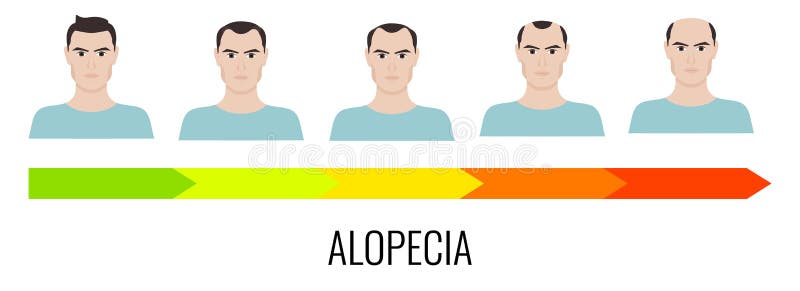 Αρσενικό alopecia σχεδίων απεικόνιση αποθεμάτων Αρσενικό alopecia σχεδίων απεικόνιση αποθεμάτων