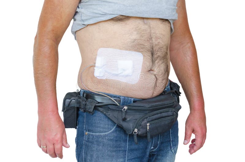 Βοηθήστε τις συσκευές, τεχνητές καρδιές, LVADs, DCM ελεύθερη απεικόνιση δικαιώματος Βοηθήστε τις συσκευές, τεχνητές καρδιές, LVADs, DCM ελεύθερη απεικόνιση δικαιώματος
