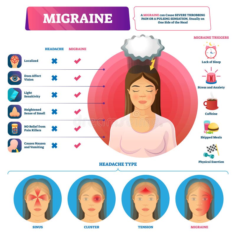 Migraine vector illustration. Labeled abdominal headache triggers and types scheme. Visualized sinus, cluster and tension pulsation head feelings. Educational strong severe throbbing pain comparison. Migraine vector illustration. Labeled abdominal headache triggers and types scheme. Visualized sinus, cluster and tension pulsation head feelings. Educational strong severe throbbing pain comparison.