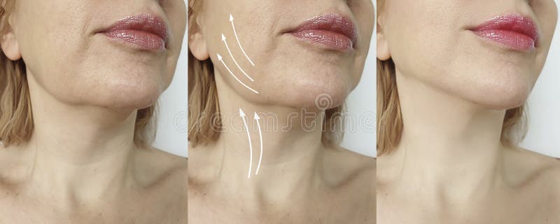 Διπλό πηγούνι γυναικών πριν και μετά από τη διόρθωση επεξεργασίας στοκ εικόνα Διπλό πηγούνι γυναικών πριν και μετά από τη διόρθωση επεξεργασίας στοκ εικόνα